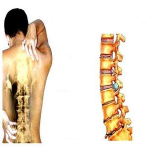 Estágios de osteocondrose