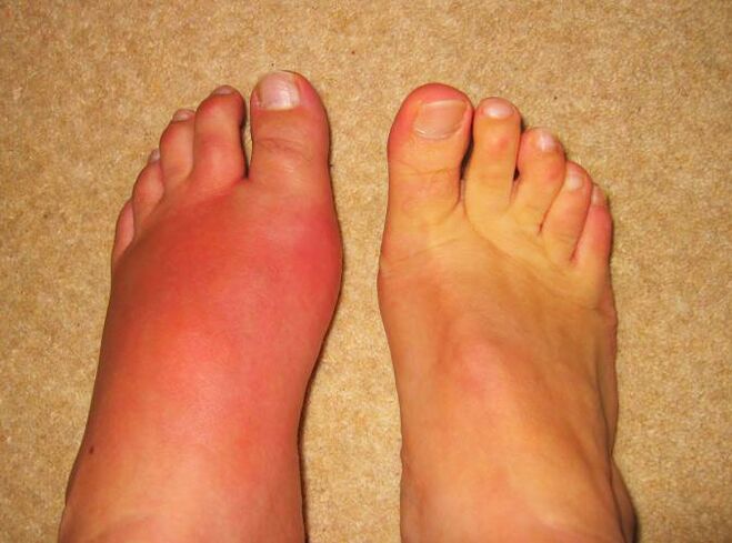 dor nas articulações das pernas devido à gota