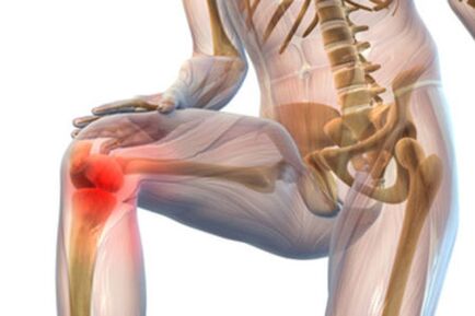Dor na articulação do joelho com artrose