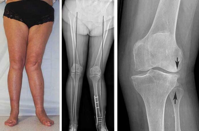 artrose avançada da articulação do joelho