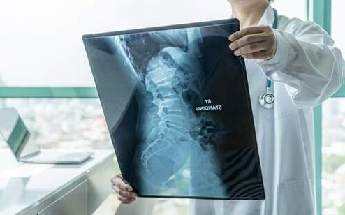 A radiografia é um método de diagnóstico necessário se as costas doerem
