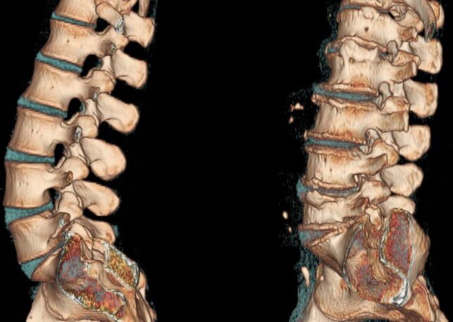 Osteocondrose da coluna vertebral em uma tomografia computadorizada