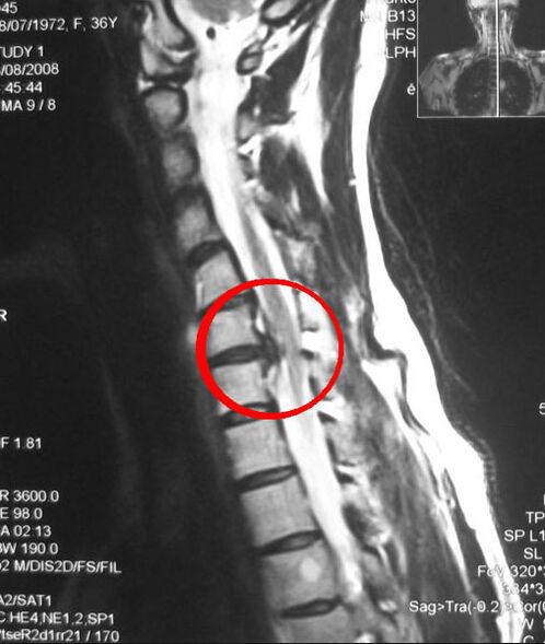 Sintomas de osteocondrose torácica em uma radiografia